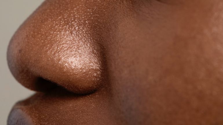 peau grasse : comment en prendre soin ?